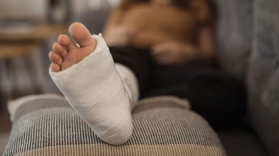 Yeso o cirugía: qué funciona mejor para fracturas de Weber B