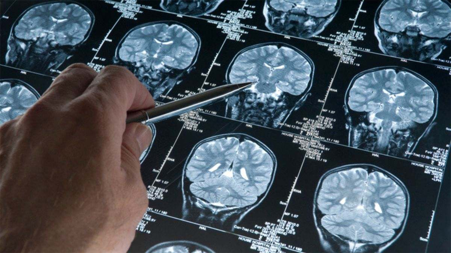 Nueva diana contra el Alzheimer: la proteína PRKCG influye en la forma en que las proteínas amiloides se ensamblan