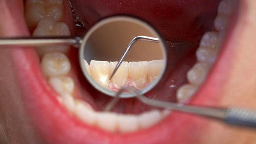 Investigadores descubren un vínculo claro entre la enfermedad renal crónica y la enfermedad periodontal