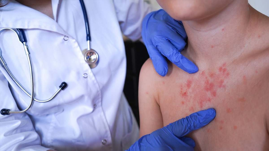 Investigadores españoles descubren cómo un medicamento usado en leucemia puede ayudar a tratar la psoriasis