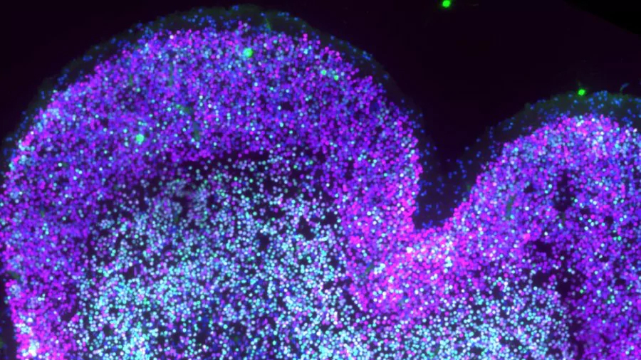 Describen cómo el síndrome de Down altera el desarrollo del cerebro antes de nacer