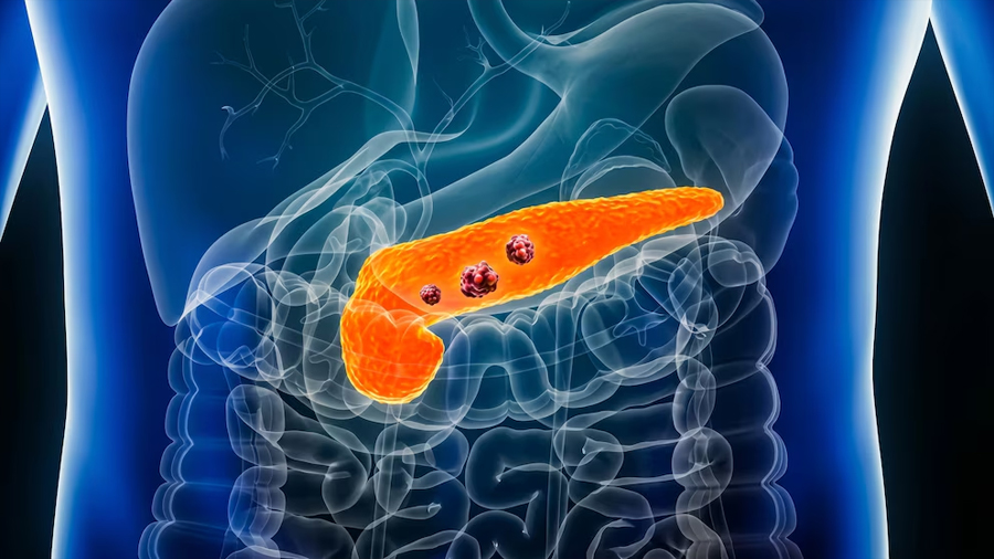Cáncer de páncreas: descubren una proteína que protege al tumor y frena las defensas del cuerpo