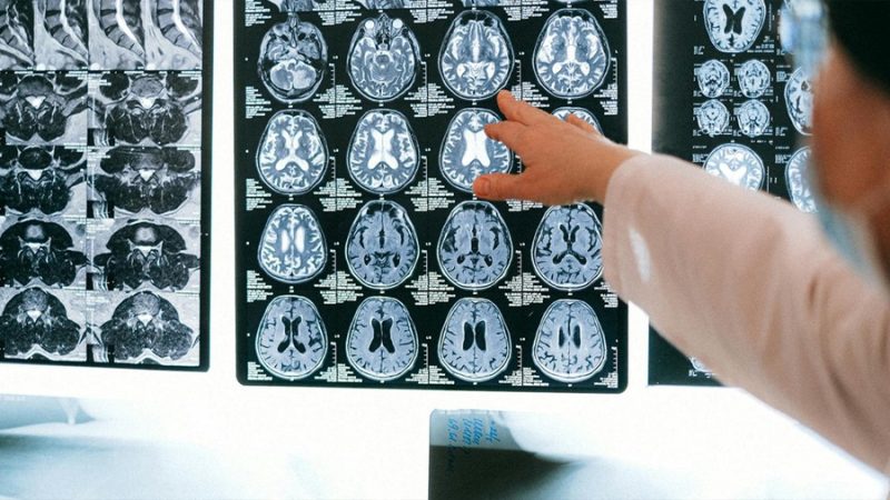 Investigadores españoles crean un parche de seda para reparar el cerebro después de un ictus