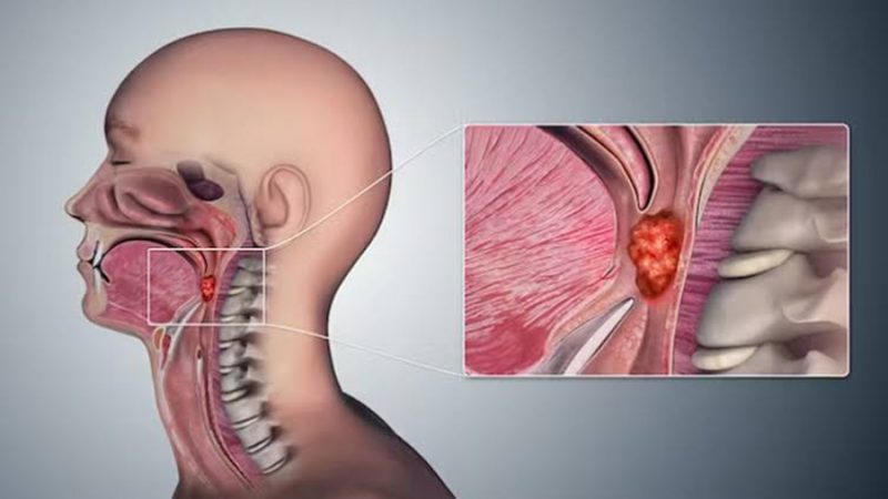 Virus del Papiloma Humano dispara casos de cáncer de orofaringe en población joven de México