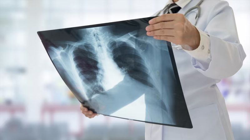 Un estudio identifica que los mecanismos biológicos de la hipertensión pulmonar difieren entre EPOC y EPID