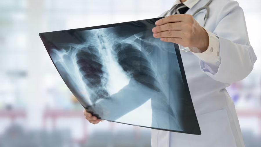 Un estudio identifica que los mecanismos biológicos de la hipertensión pulmonar difieren entre EPOC y EPID