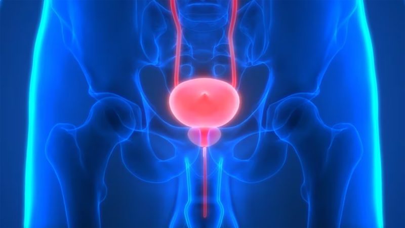 Intensificar el tratamiento antes y después de la cirugía mejora el pronóstico en cáncer de próstata, según un estudio