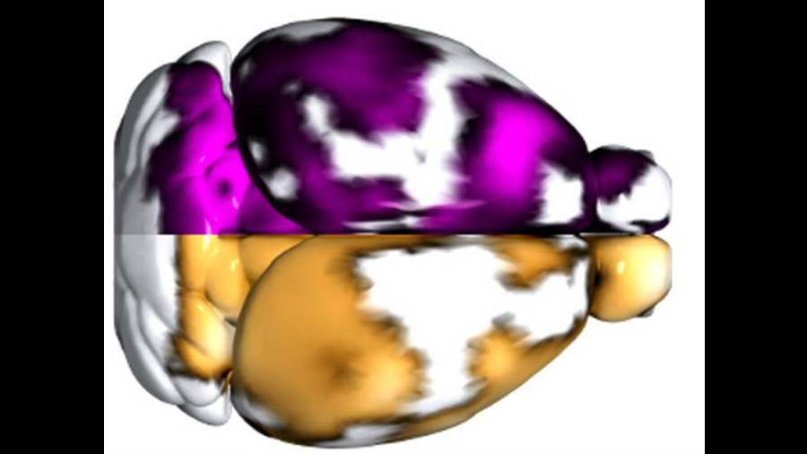 Técnica de imagen no invasiva que permite localizar por vez primera los microtrombos que agravan el alzhéimer