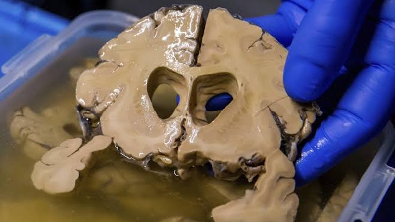 México presenta una tecnología innovadora para el tratamiento de aneurismas cerebrales