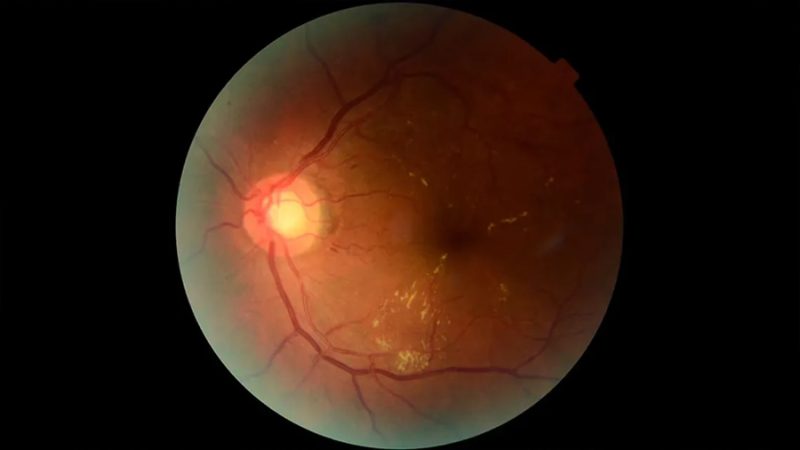 Científicos argentinos crean una IA para prevenir la pérdida visual por diabetes
