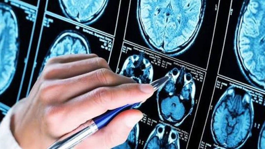 Investigadores descubren células inmunitarias que protegen al cerebro del Alzheimer