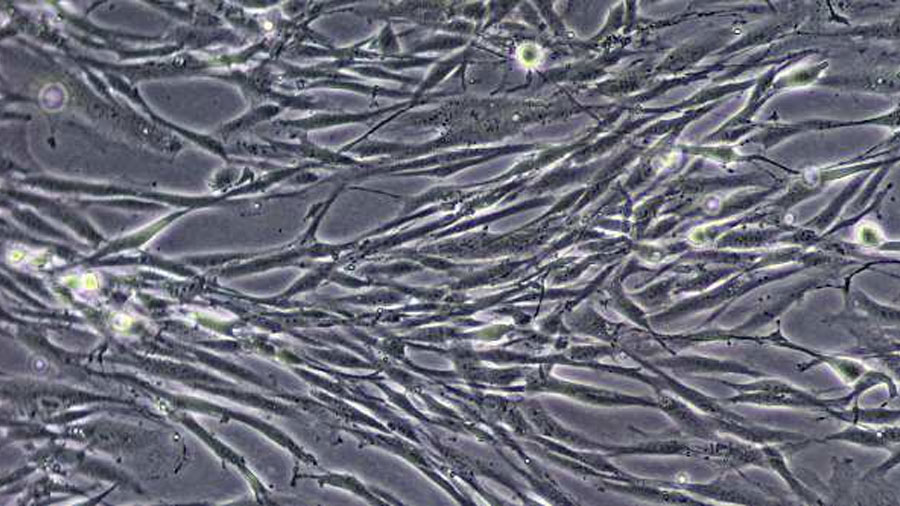 Descubren cómo un cáncer de hígado muy agresivo resiste la quimioterapia