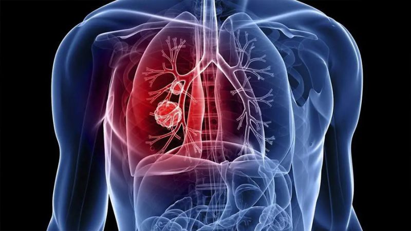 Falta de aire y dolor de pecho, señales de alerta de una posible embolia pulmonar: especialista