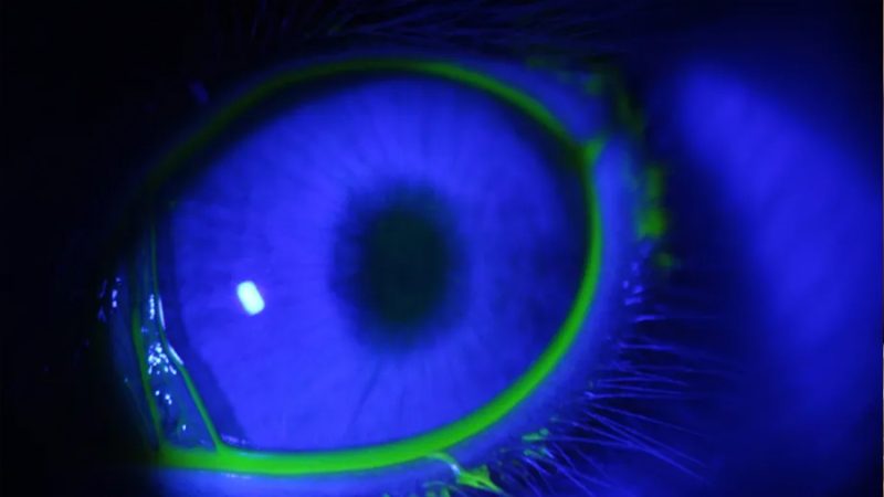 ¿Chau a las gotas? Científicos argentinos crean un minidispositivo 3D contra el glaucoma