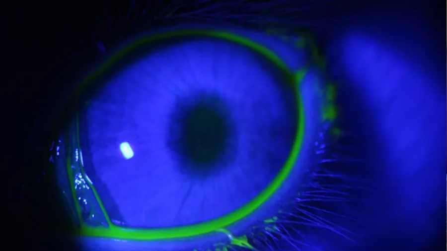 ¿Chau a las gotas? Científicos argentinos crean un minidispositivo 3D contra el glaucoma