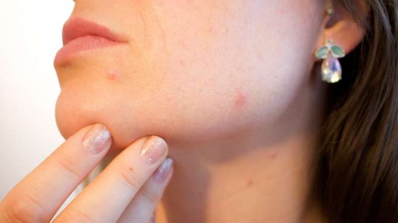¿El acné es estacional? La ciencia tras los brotes en verano e invierno