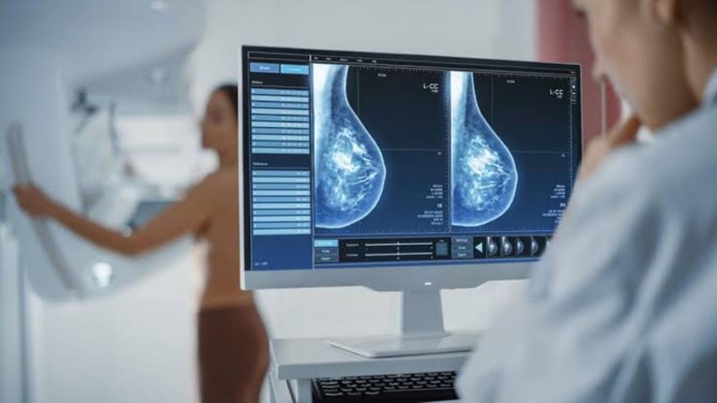 Descubren nueva vía para detener metástasis en cáncer de mama mediante RAC1