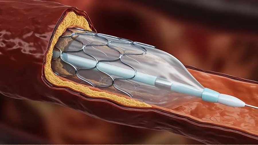 Adiós al stent coronario: investigadores de Reino Unido descubren un tratamiento igual de eficaz para prevenir infartos